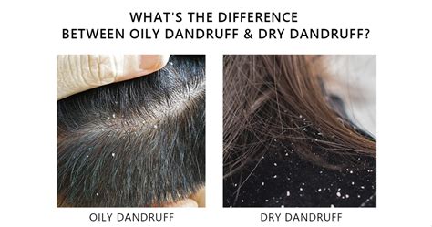 Oily Dandruff Vs Dry Dandruff Learn The Causes And Differences Aromase