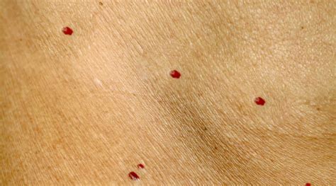 Red Moles On Skin