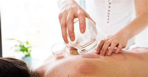 Cupping Therapy—what Is It And Should You Try It