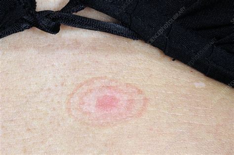 Ringworm Tinea Fungal Skin Infection Stock Image C011 7542