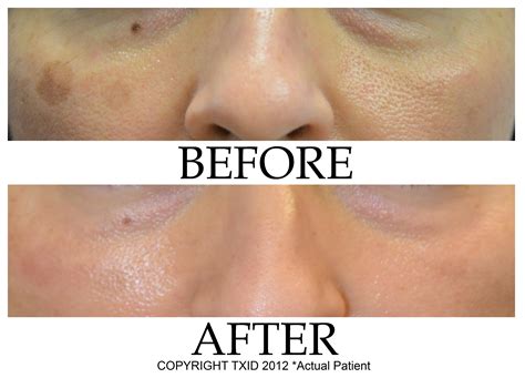 Pigmented Spots San Antonio Dermatology