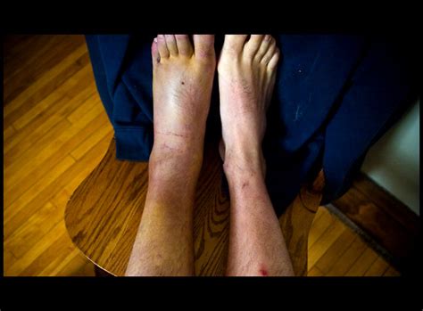 At this point, cats usually look. broken ankle 1 | The American medical system is f-ed. On ...