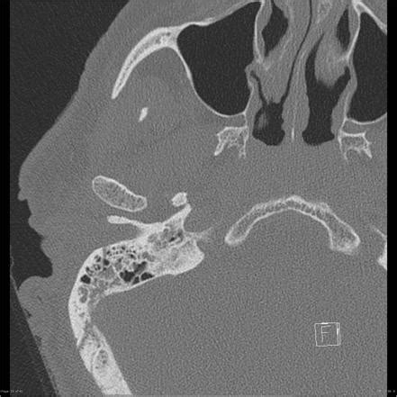 Petrous Temporal Bone Fracture