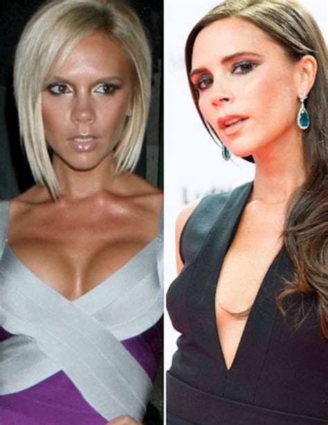 Victoria Beckhams Breast Implants Spice Girl Opens Up About Boob Job