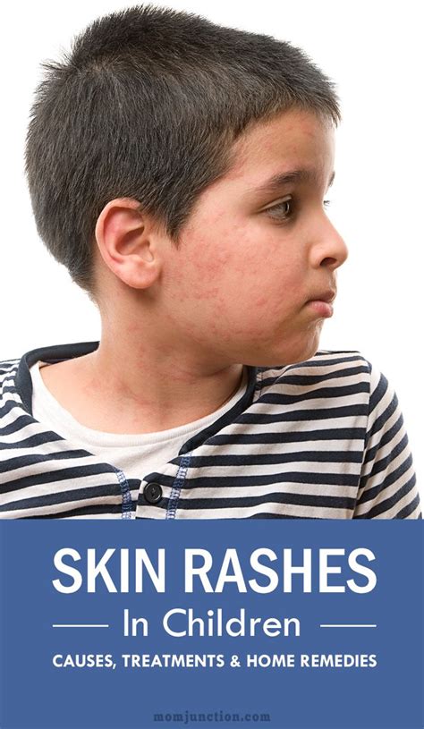 Best 25 Skin Rashes In Children Ideas On Pinterest Rashes On Body