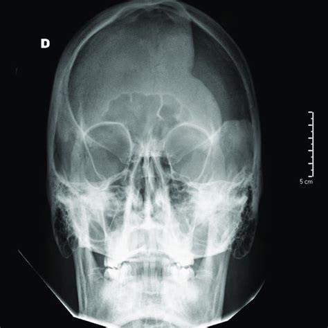 Antero Posterior Skull X Ray Obtained Three Months After Cranioplasty