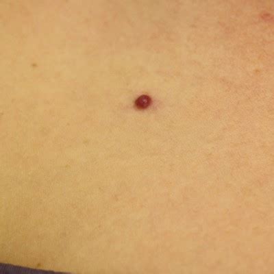 They range in colour from bright red to purple. Cherry Angioma Campbell Morgan | London Mole Removal