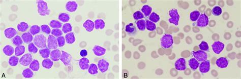 Mantle Cell Lymphoma In Leukemic Phase Wong 1999 Cancer Wiley