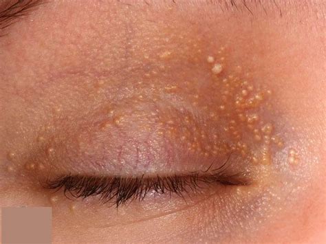 Milia Eyelid White Bumps On Face Not Milia Milia Causes Treatments
