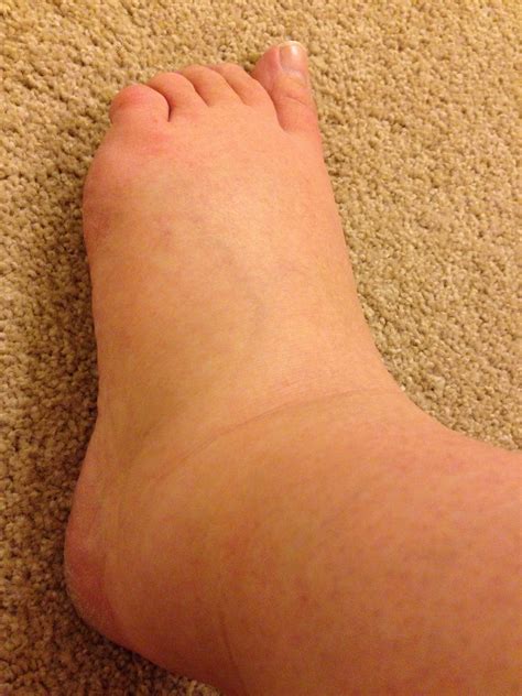 White Spots On Swollen Feet During Pregnancy Pregnancywalls