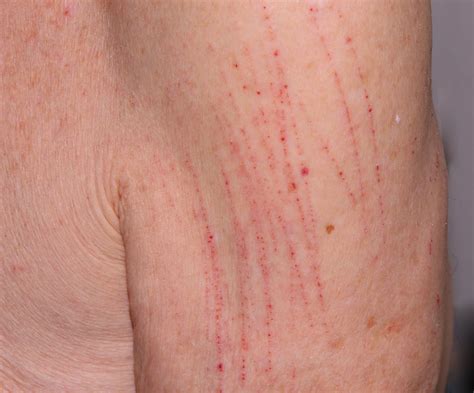 Non Hodgkins Lymphoma Skin Rash Pictures Naturalskins