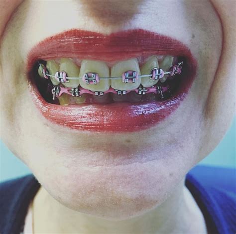 Pin De Jamie Richie En Braces And Retainers Orthodontics Ortodoncia Brackets Boca