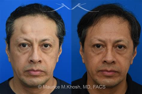 New York Facial Lipoma Removal Causes Treatment Manhattan Nyc