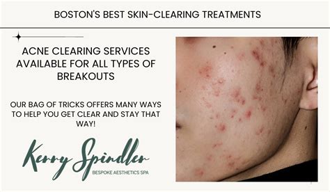 Kerry Spindler Bespoke Aesthetics Spa Skin Care Solutions For Acne