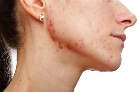 How Does Acne Inflammation Cause Scars With Pictures