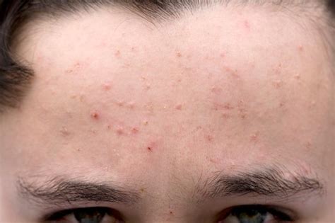 How To Get Rid Of Comedones On Forehead Drumposts