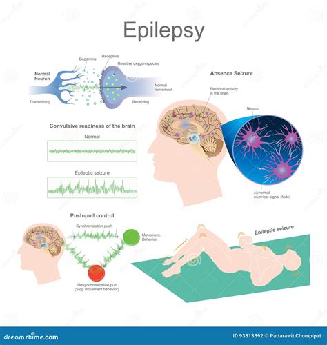 Epilepsie Ursachen Symptome Und Behandlung Liebenswert