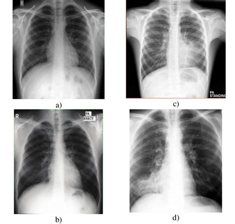 Video includes the following image (among others): present some samples of normal and pneumonia lung x-ray ...