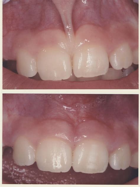 Labial Frenectomy Before And After