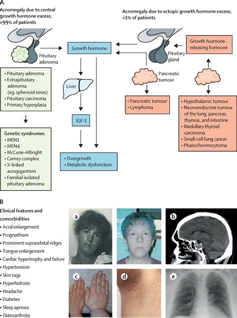 acromegaly pathogenesis diagnosis and management the lancet diabetes and endocrinology