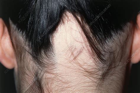Alopecia Areata Hair Loss Stock Image M1080544 Science Photo Library