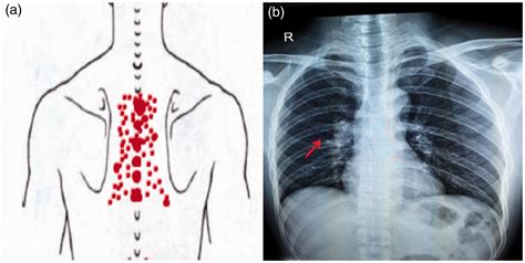 Mediastinal Tuberculous Lymphadenitis Presenting With Insidious Back