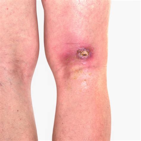 How To Tell If You Have A Wound Infection Urgentmed