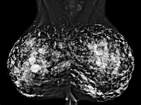 Silicone Granulomas Radiology Cases