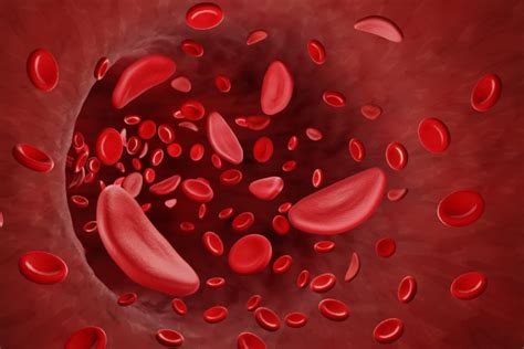 Experimental Gene Therapy Reverses Sickle Cell Disease For Three Years