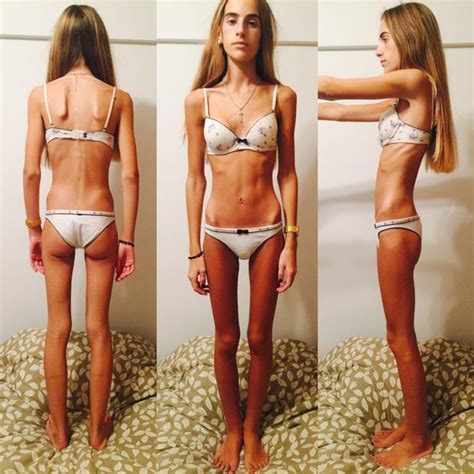 Teen Who Weighed Just 35kg Because Of Anorexia Battle Now On