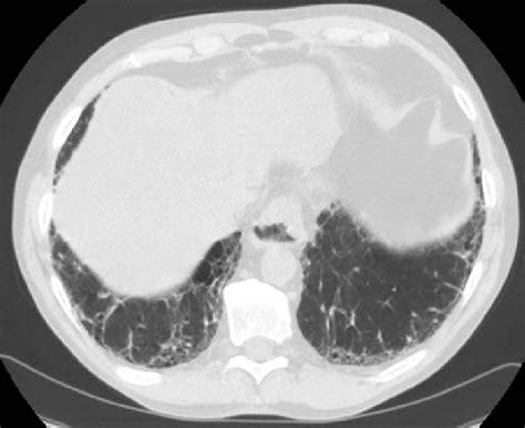 Subpleural Intralobular Interstitial Thickening Reticulation And