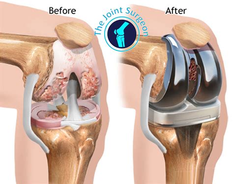 Fast Track Total Knee Replacement Surgery Welcome To The Joint