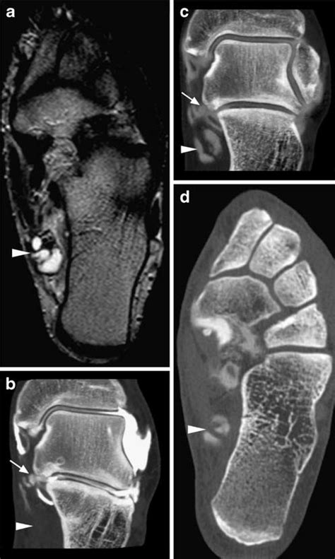 Tarsal Tunnel Syndrome Mri Captions Beautiful