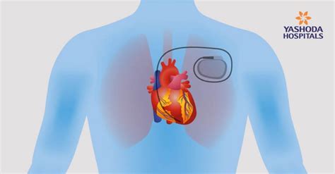 Pacemaker Surgery Procedure Risks Complications And Benefits