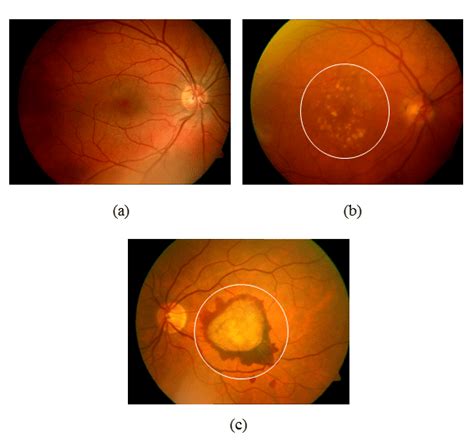 Examples Of Retinal Images A Normal Retina B Retina Displaying