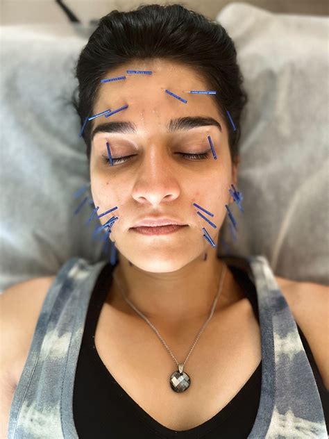 Facial Acupuncture Lien On Me Acupuncture