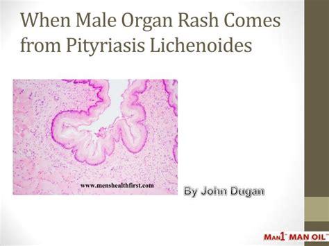 Ppt When Male Organ Rash Comes From Pityriasis Lichenoides Powerpoint