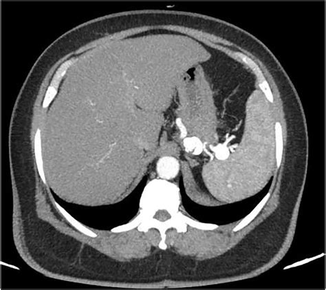 Axial Abdominal Ct Scan Picture Showing Two Splenic Artery Aneurysms
