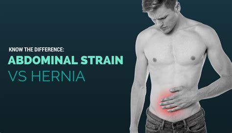 Know The Difference Abdominal Strain Vs Hernia What Is Posts And