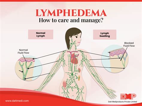 Lymphedema How To Care And Manage Blog By Dmp