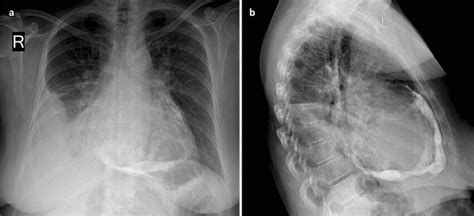 Posteroanterior A And Lateral View B Of The Patients Chest X Ray