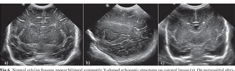 Figure 9 From Neonatal Head Ultrasound Systematic Approach To