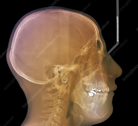 Jaw Cancer Ameloblastoma X Ray Stock Image C0095472 Science