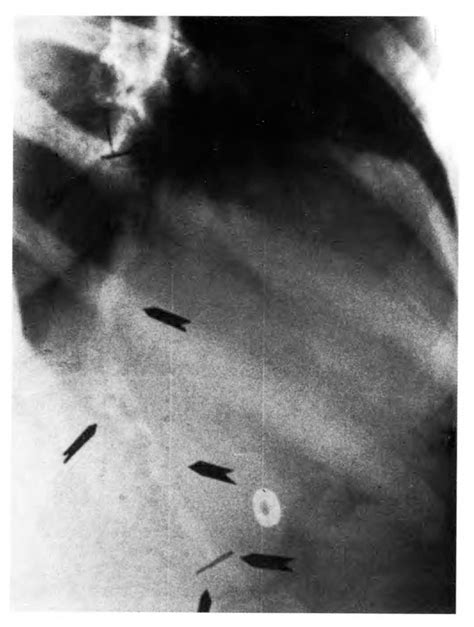 A Case Of An Abnormally Long Xiphoid Process Presenting As An