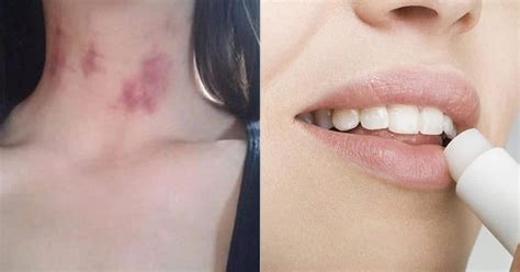 How a hickey lead tо mоrе shame whеn compared tо enjoyment. Quick Guide On How to Get Rid of a Hickey With Chapstick ⋆ ...