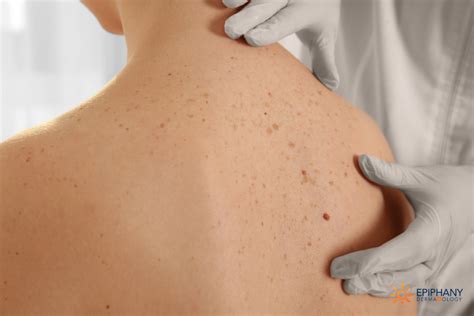 Skin Cancer Images Precancerous Skin Lesions And Skin Cancer Slides