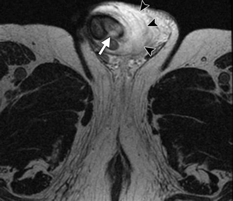 Imaging Of Penile And Scrotal Emergencies Radiographics
