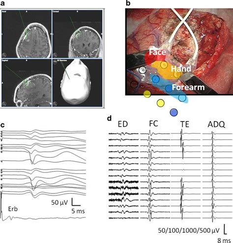 Role Of Intraoperative Neurophysiological Monitoring During