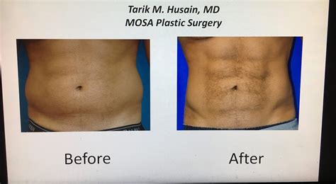 A Liposuction Procedure Promises Pack Abs Without Lifting A Finger