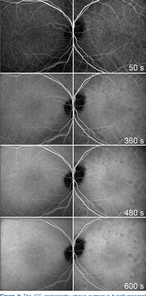 Figure 2 From Hip Implant Related Chorio Retinal Cobalt Toxicity